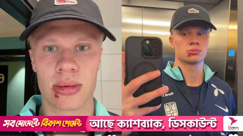হলান্ডের মুখে তিন সেলাই